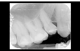 Endodoncia antes 1