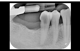 Endodoncia antes 2