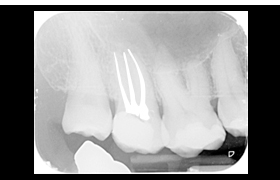 endodoncia despues 1