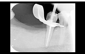 endodoncia despues 2