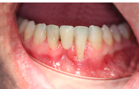 Periodoncia antes 1