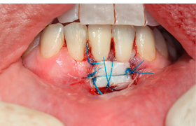 Periodoncia antes 2